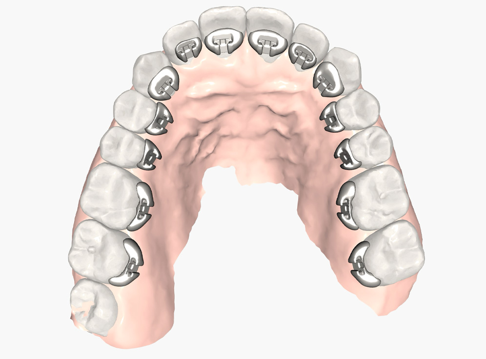 intraoral scan image that shows Brava brackets by brius