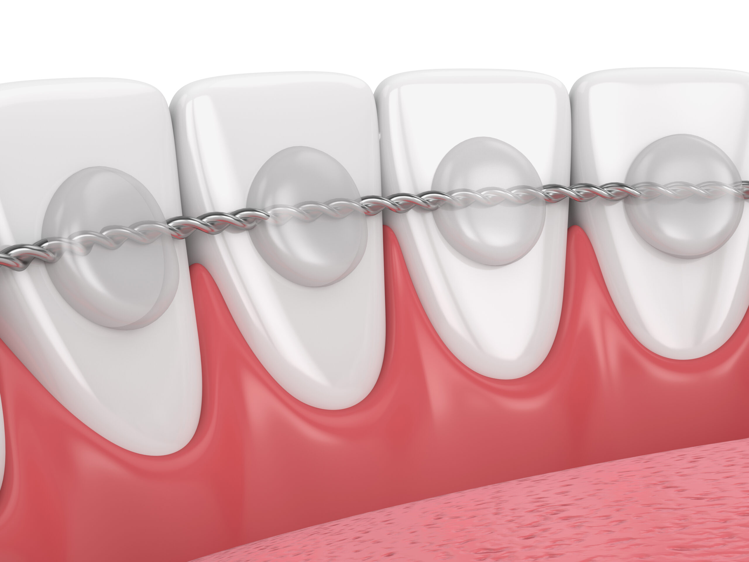 3d render of dental bonded retainer on lower jaw over white background