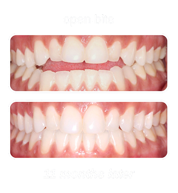 Open Bite 1