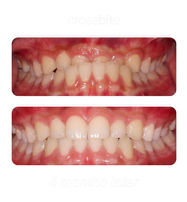 crossbite 1