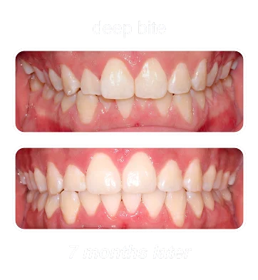 Deep-Bite-1-e1759851179888
