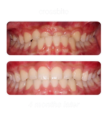 crossbite-1-e1759851278671